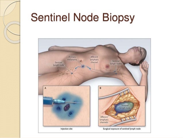 biopsy of the vulva Biopsy of the vulva